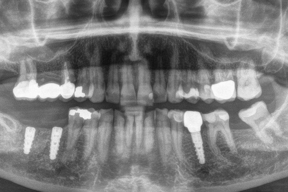 Neuraltherapie Zahn-Kiefer Region