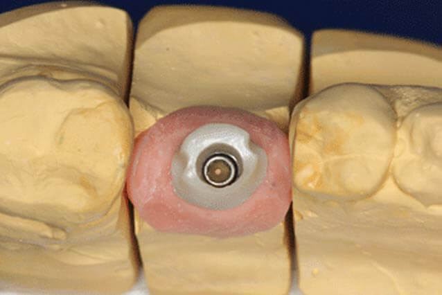 Implantat Beispielfoto