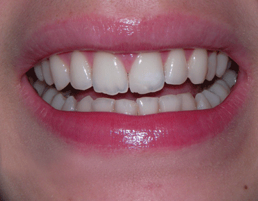 Frontzähne nach Zahnspange